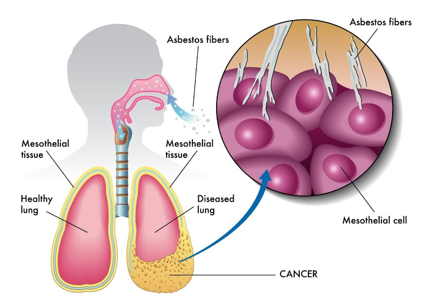mesothelioma diagram. friable asbestos, non friable asbestos