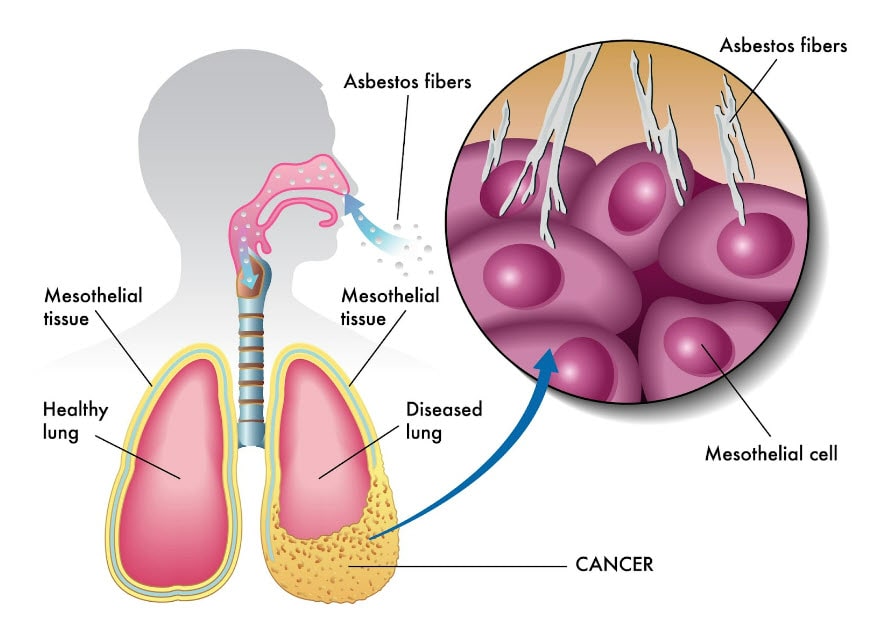 mesothelioma-diagram